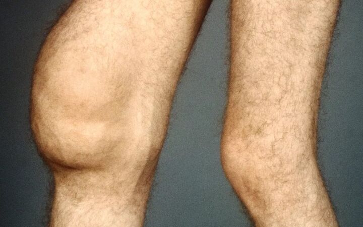 Post-TRAUMATICAL arthrosis of knee combination