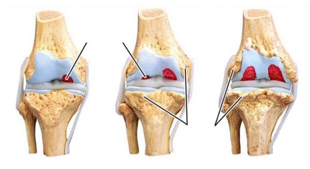 Aggravation of arthrosis of compounds