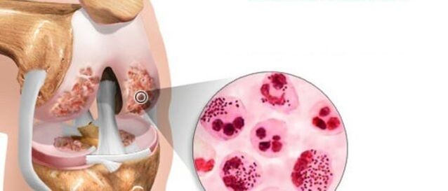 which lead to the development of arthrosis