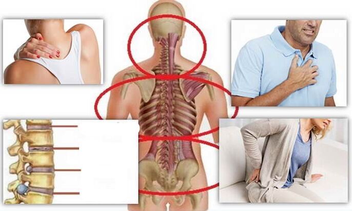 Disease places for osteocondrosis