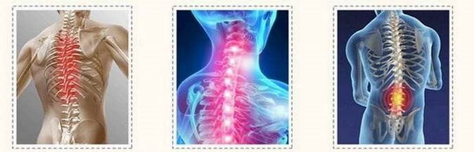 Osteocondrosis spinal lesions