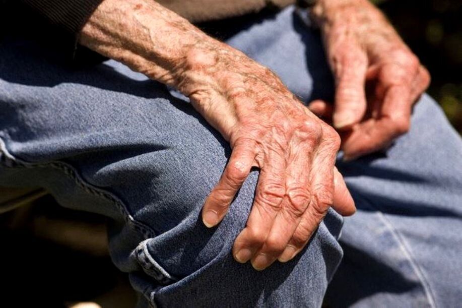 Arthritis is an age-related disease that occurs in older people