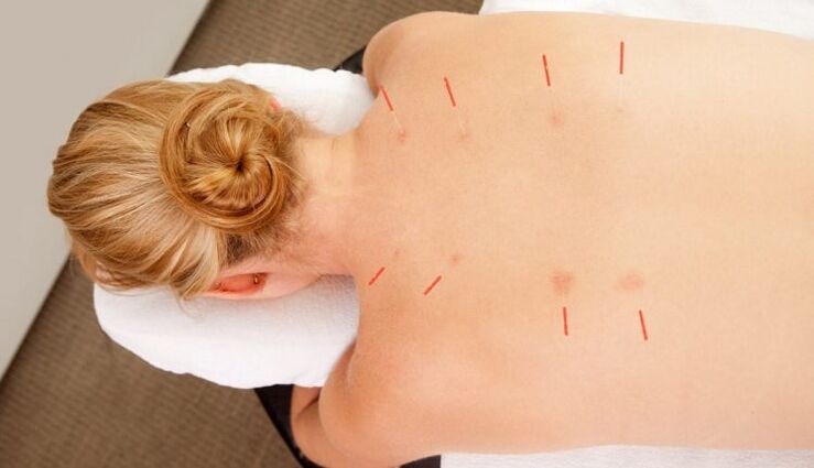 Acupuncture for thoracic osteochondrosis with many advantages